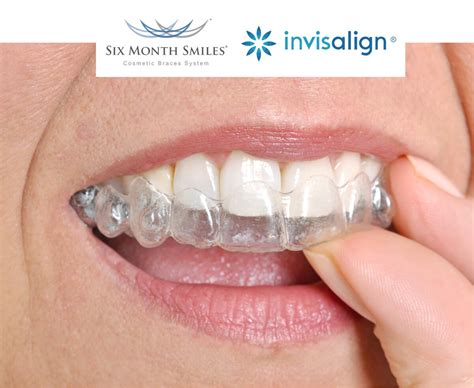Invisalign Six Months Smile