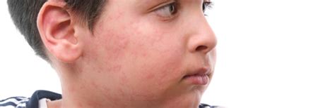 How To Identify Common Rashes And Skin Conditions In Children Green