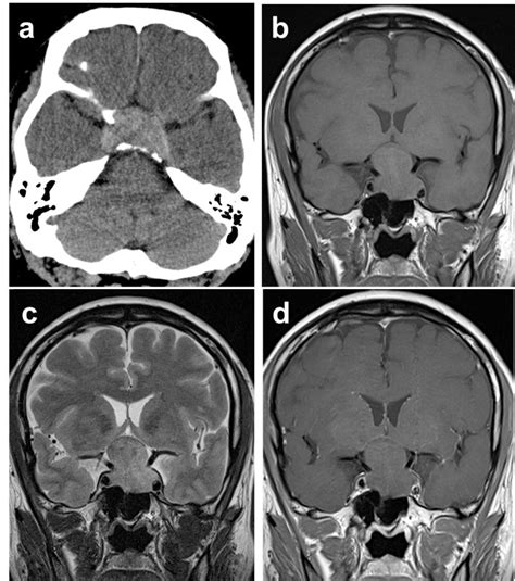 Pituitary Macroadenoma Radiology Cases