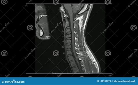 Magnetic Resonance Images Of Cervical Spine Sagittal T1 Weighted Images