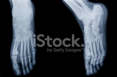 Human Leg X Ray Stock Photos