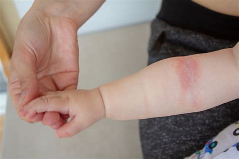 Baby Heat Rash Causes Types With Pictures And Remedies