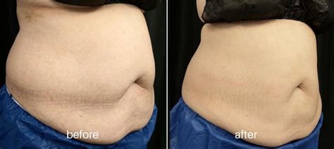 Coolsculpting Freeze Fat In Cerritos And Costa Mesa Belle Vie Wellness And Aesthetics