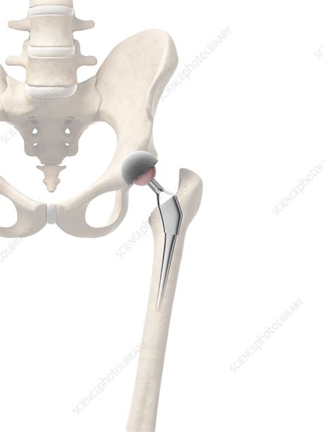 Human Hip Replacement Artwork Stock Image F009 6895 Science Photo Library