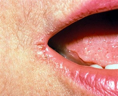 10 Best Home Remedies For Angular Cheilitis Cracked Corners Of Mouth
