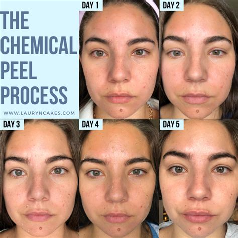 Jessner Chemical Peel Beforeafter Photos Of The Proven Facial Lauryncakes Chemical Peel