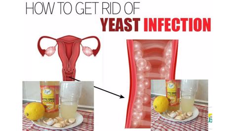 HOW TO TREAT YEAST INFECTION VAGINA ODOUR IN DAYS YouTube