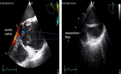 Dilated Aortic Root On Transoesophageal Echo With Evidence Of