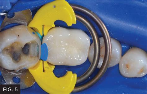Creating The Ideal Class Ii Resin Restoration Clinical Research Dental