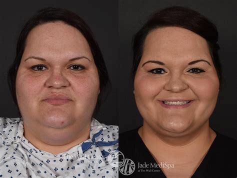 Double Chin Reduction Case 576