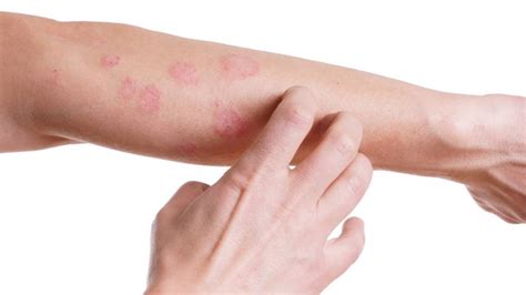 Dermatite Allergica 7 Cose Da Sapere Assolutamente Myskin