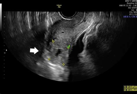 Cureus Interstitial Pregnancy Case Report Of Atypical Ectopic Pregnancy