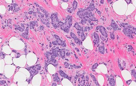 Invasive Ductal Carcinoma Of The Breast Mypathologyreport Ca