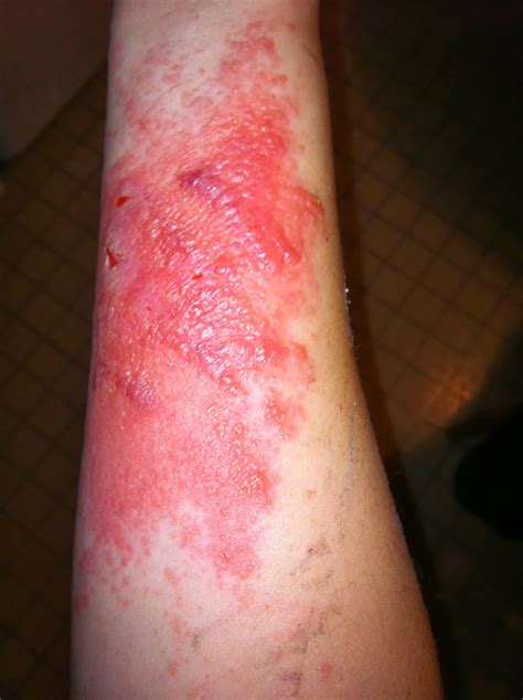 Poison Ivy Rash Fact About Rash Symptoms And Treatment Digest Ground