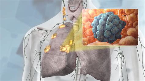 Stage Lung Cancer All That You Need To Know Scientific Animations