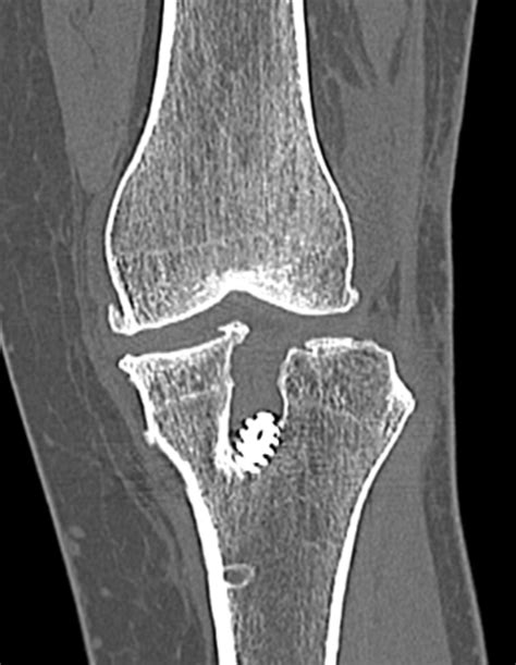 Revision Acl Reconstruction — Adam B Cohen Md