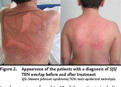 Evaluation Of The Patients Diagnosed With Stevens Johnson Syndrome And