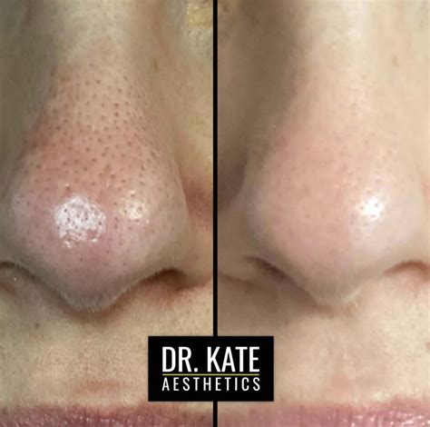 5 benefits of using chemical peels from dr kate aesthetics aesthetics and skin care clinic in