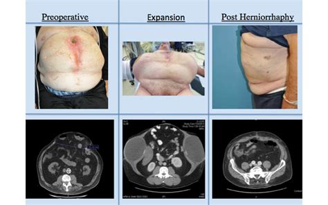 Nesps Abdominal Wall Expansion With Anterior Component Separation