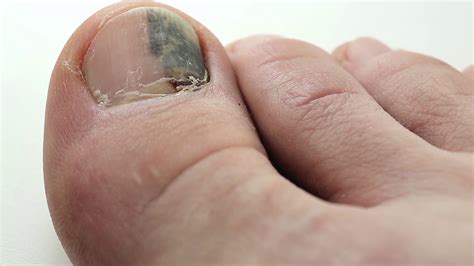 Trauma Of Toenail Subungual Hematoma Bruise Under The Nail Of Big Toe