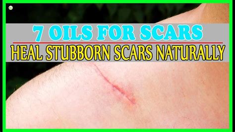 Best 7 Essential Oils For Scars How To Get Rid Of Scars Naturally