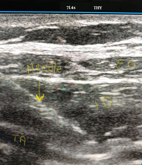 Picture Of Ultrasound Guided Ilioinguinaliliohypogastric Nerve Block