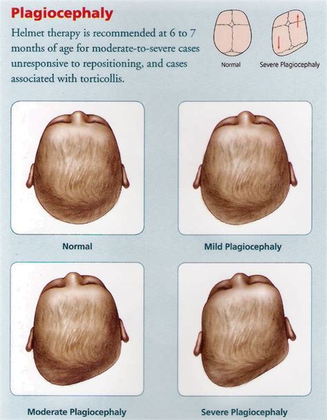 Punca Bayi Alami Sindrom Flat Head And Ini 6 Bantal Yang Sesuai Untuk
