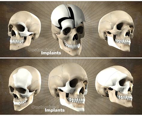 Multiple Customized Skull Implants A Kyu Design