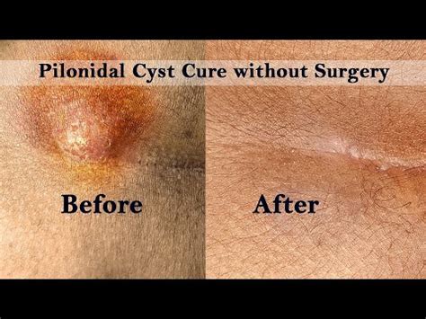 Pilonidal Cyst Removal Without Surgery Youtube