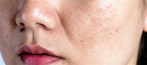 Flaky Skin On Face Meaning Causes How To Get Rid Of Dry Flaky Skin
