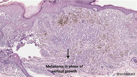 Malignant Melanoma Histology