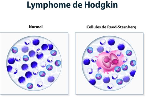 Les Lymphomes Causes Symptômes Et Traitements Information