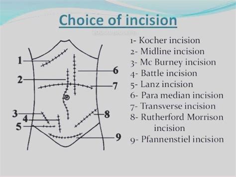 Doctordconline “different Types Of Incision Incision Surgery