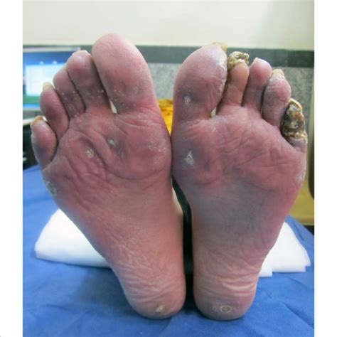 Pdf Foot Pain And Lesions In Systemic Sclerosis Prevalence And