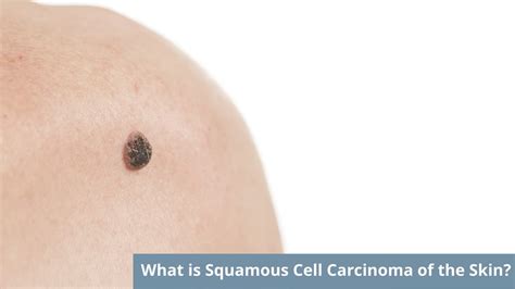 What Is Squamous Cell Carcinoma Of The Skin Apollo Hospitals Blog