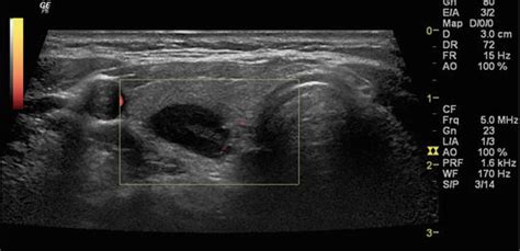 Parathyroid Gland Ultrasound
