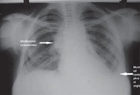 X Ray Chest Of Mother Showing Enlarged Medias Nal Lymphnodes And Blun