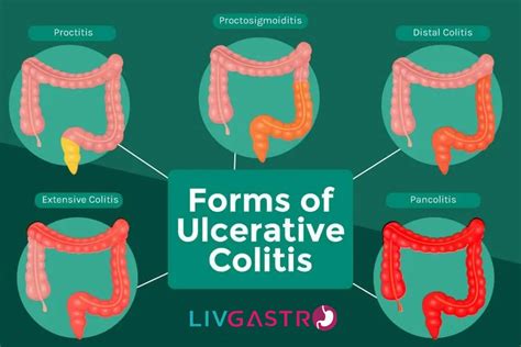 Ultimate Guide To Colitis Types Causes Symptoms And Treatment