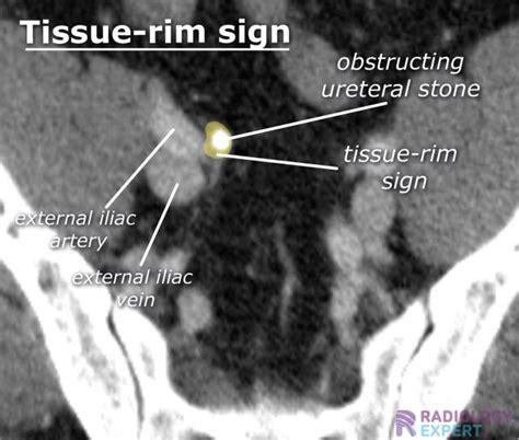 Ct Abdomen General