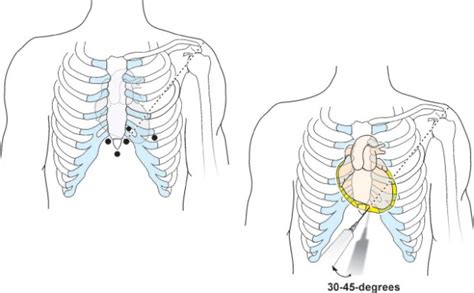 Temporary Transvenous Pacemaker Placement Thoracic Key