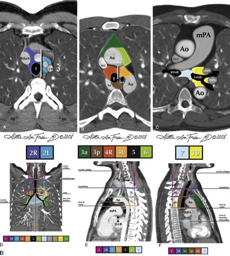 Mediastinum Lymph Node Abnormalities And Masses Radiology Key