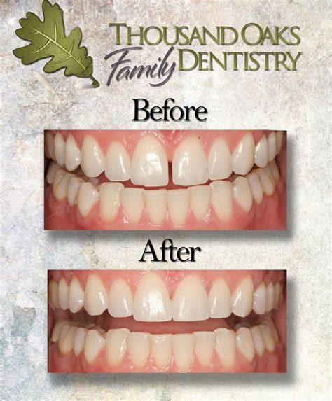 If your tongue presses against your front teeth, the pressure can push the front teeth. #bonding before and after to close gap between front two ...