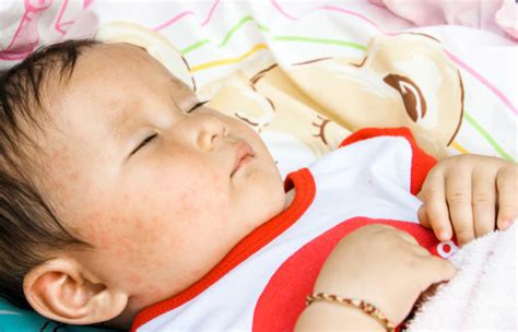 Has Your Child Has Roseola If Not And Even If So Heres What You