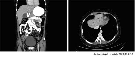 Spontaneous Hepatic Portal Venous Gas In A Patient With Ulcerative