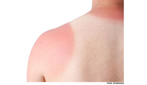 Top Most Embarrassing Yet Common Tan Lines