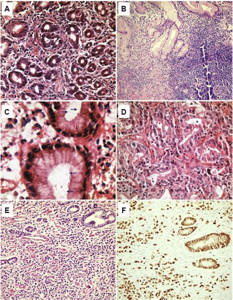 Mild Gastritis A Severe Gastritis B Helicobacter Pylori Organism