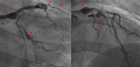 Cureus Complicated Spontaneous Coronary Artery Dissection Scad