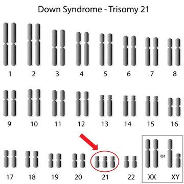 Flat face, short neck, and a degree of mental delay (mental retardation). Prenatal Testing for Down Syndrome: Understanding Two New ...