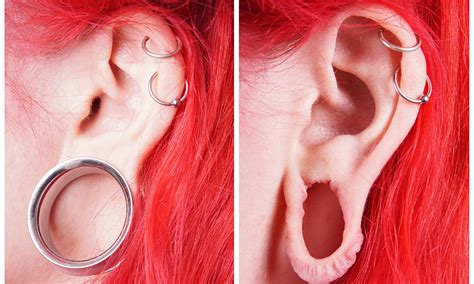 Earlobe Repair Surgery For Stretched Or Split Ear Lobes Earlobes