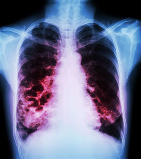 Rare Case Of Diffuse Bronchiectasis Caused By Sarcoidosis